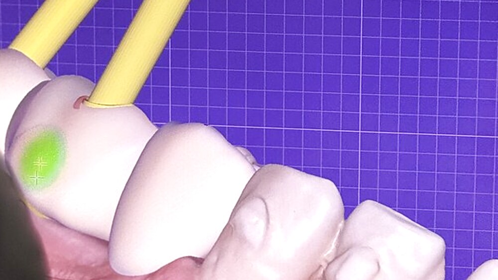 All-on-4: Dientes Fijos en un Día con Solo Cuatro Implantes