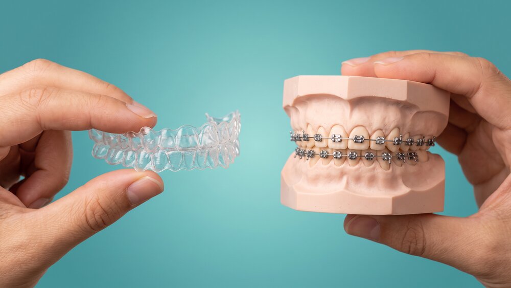 ¿Brackets o alineadores? La comparación honesta que nadie te da